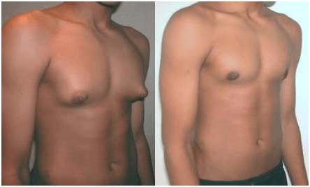 Before and After Gynaecomastia Surgery