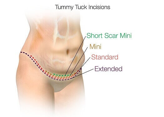 Tummy Tuck Incisions