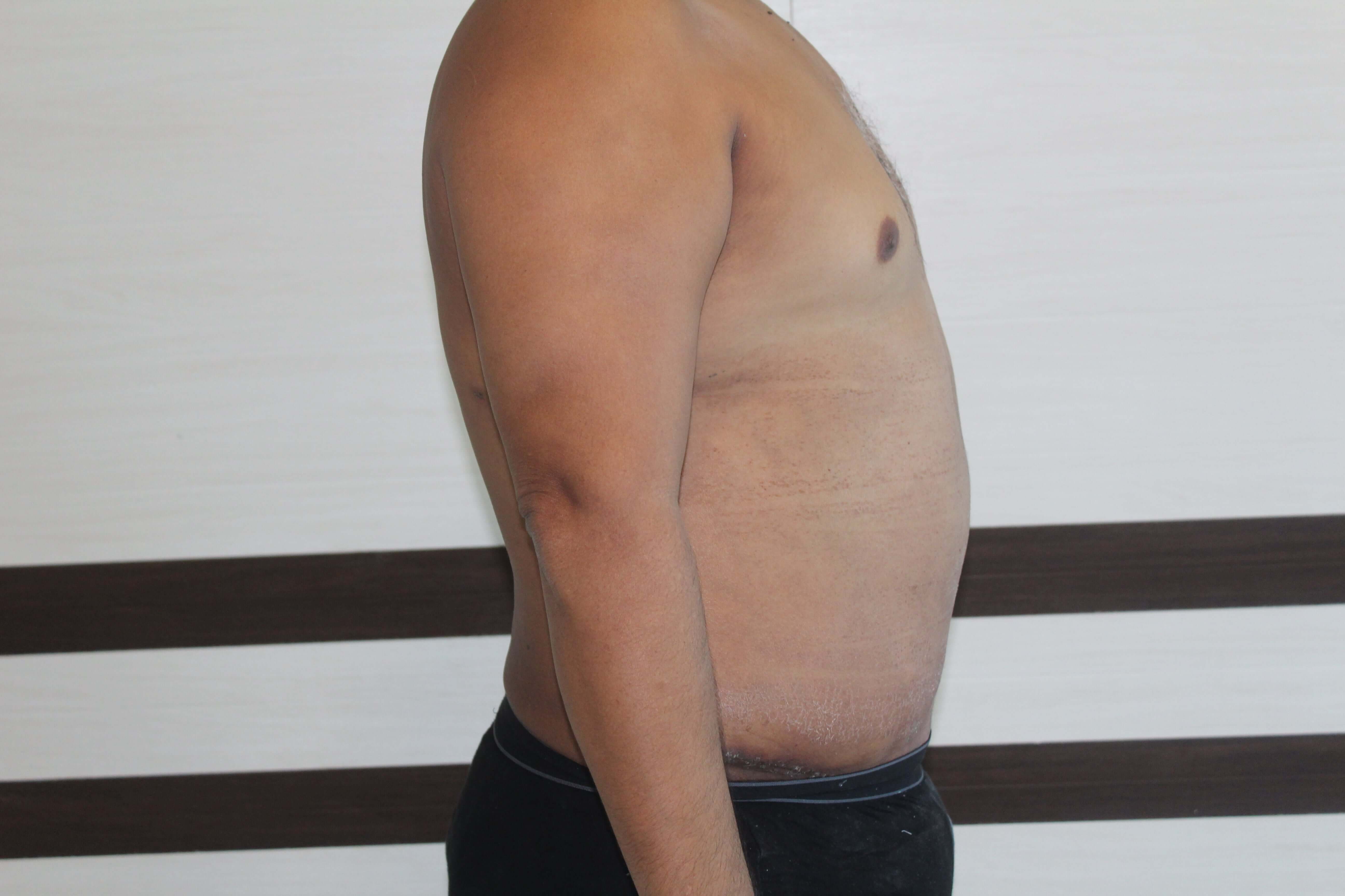 After Tummy Tuck Surgery