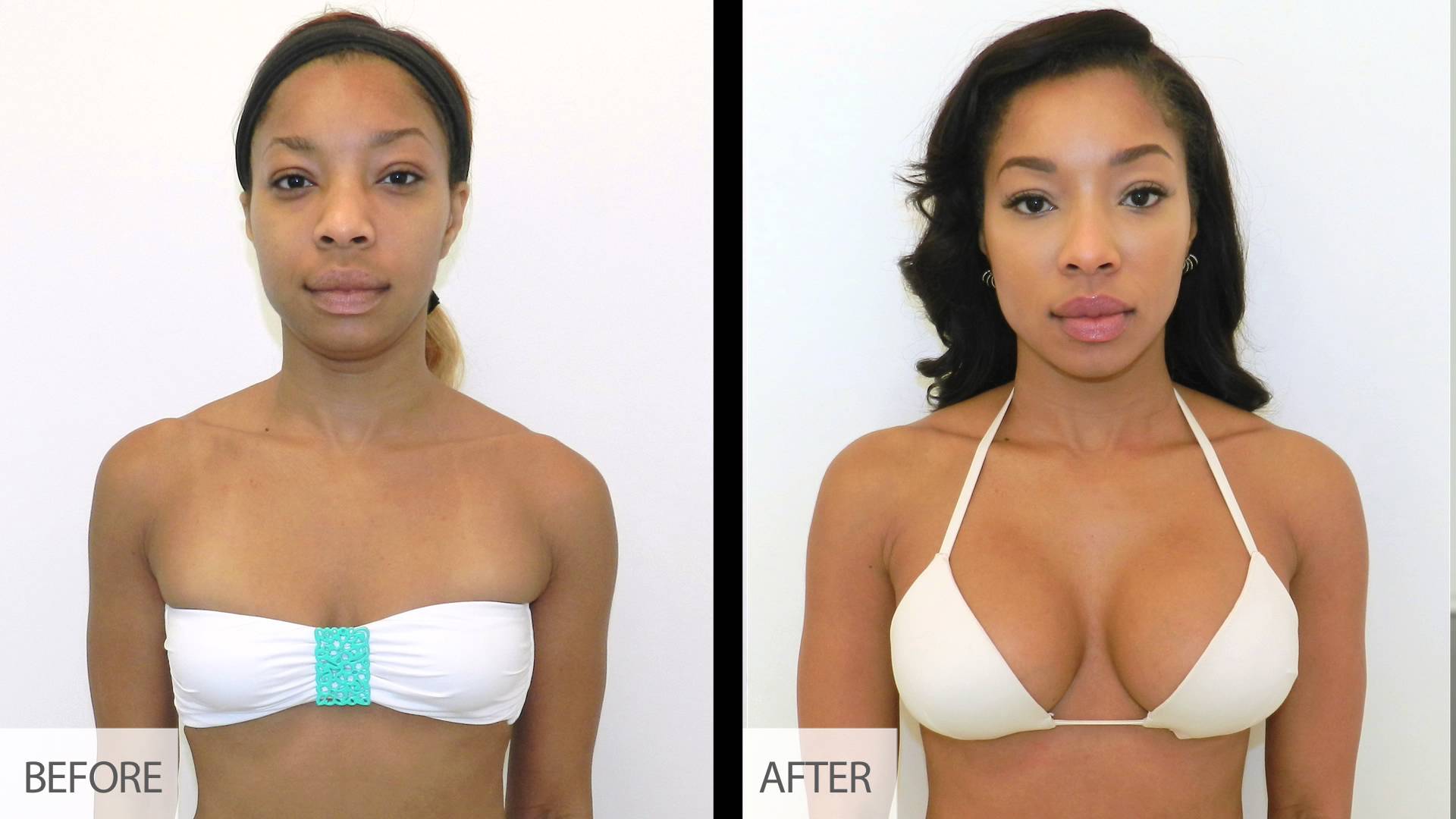 Before and After Breast Augmentation Surgery