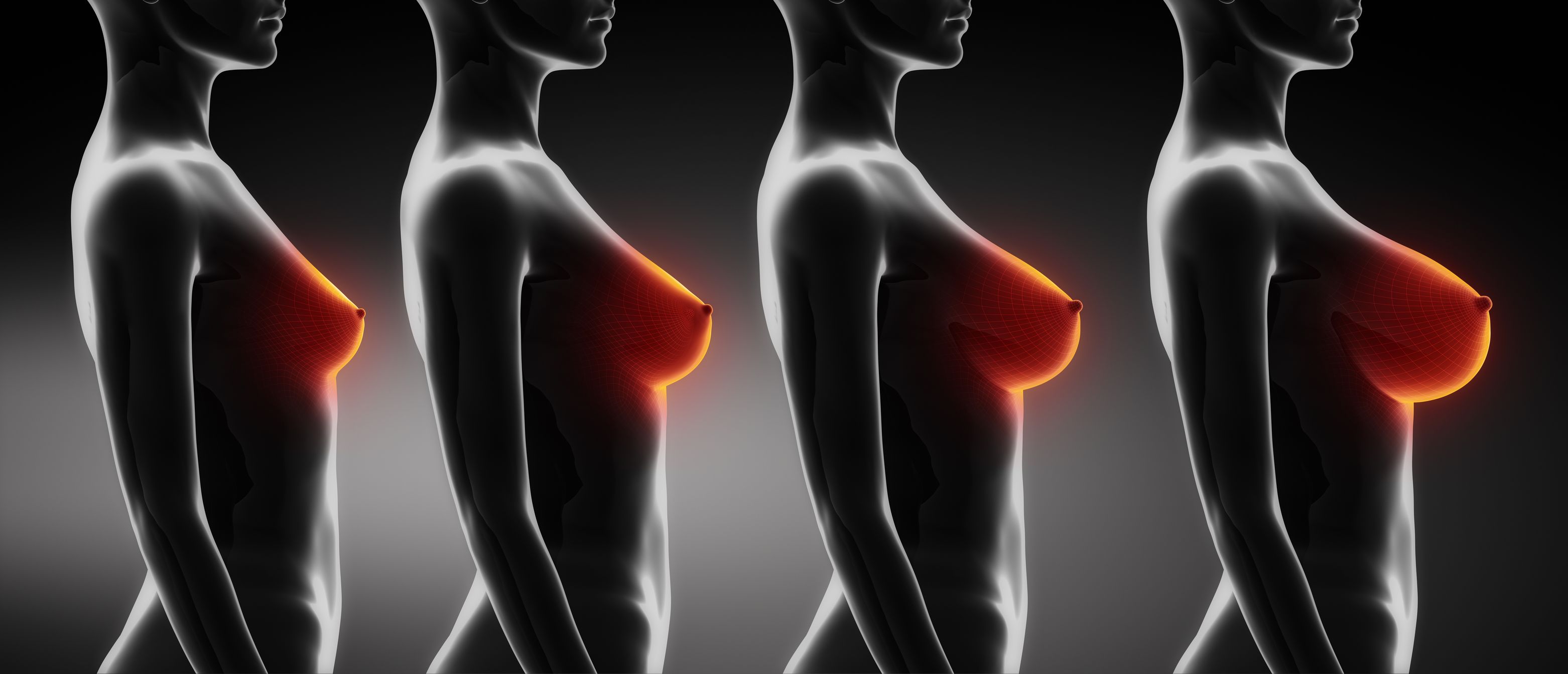 Breast Augmentation Stages