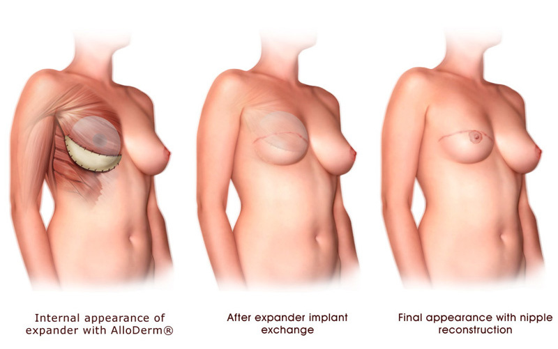 Breast Reconstruction Surgery Procedure