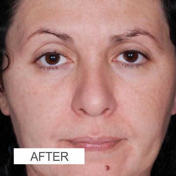 After CHEMICAL PEELS