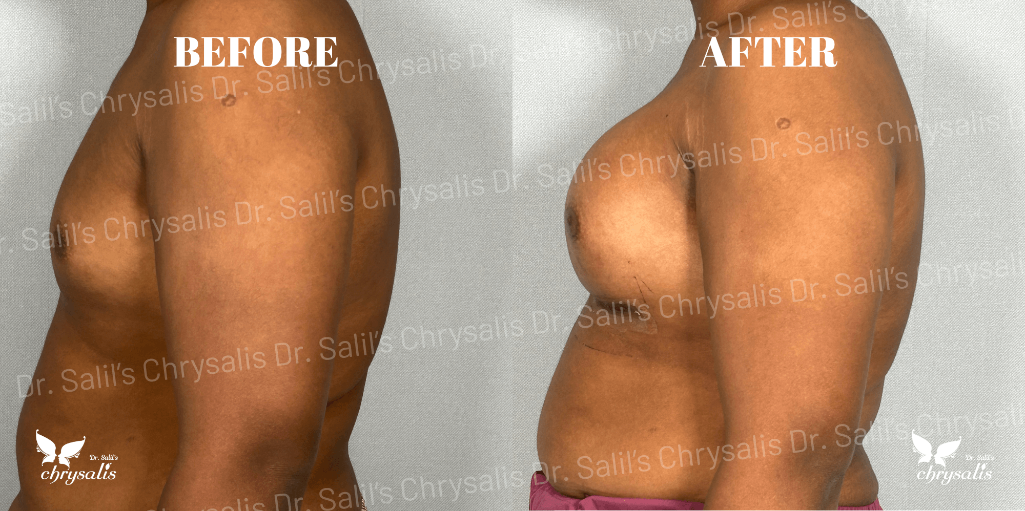 breast implant before and after Chrysalis Clinic Pune