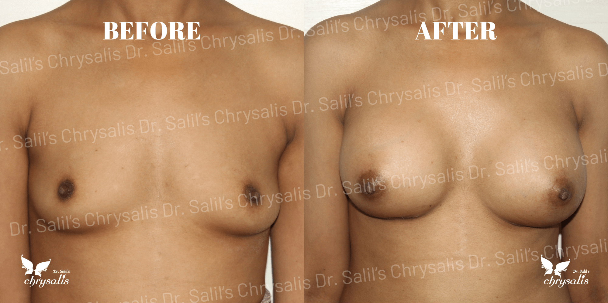 breast implant before and after Chrysalis Clinic Pune