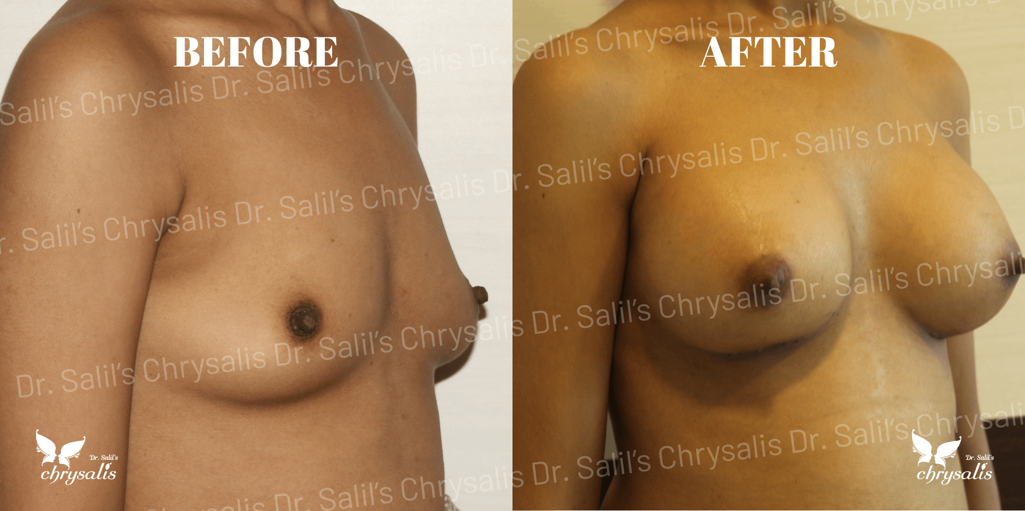 breast implant before and after Chrysalis Clinic Pune