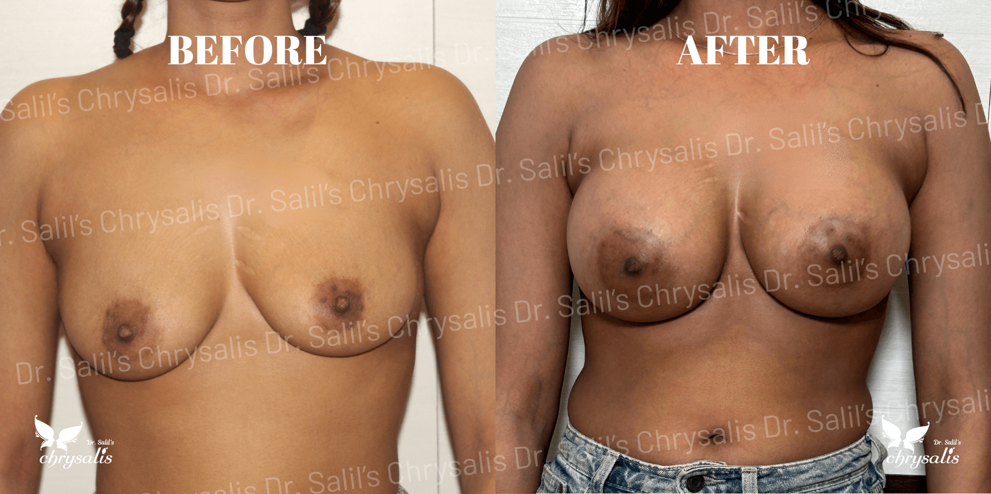 breast implant before and after Chrysalis Clinic Pune