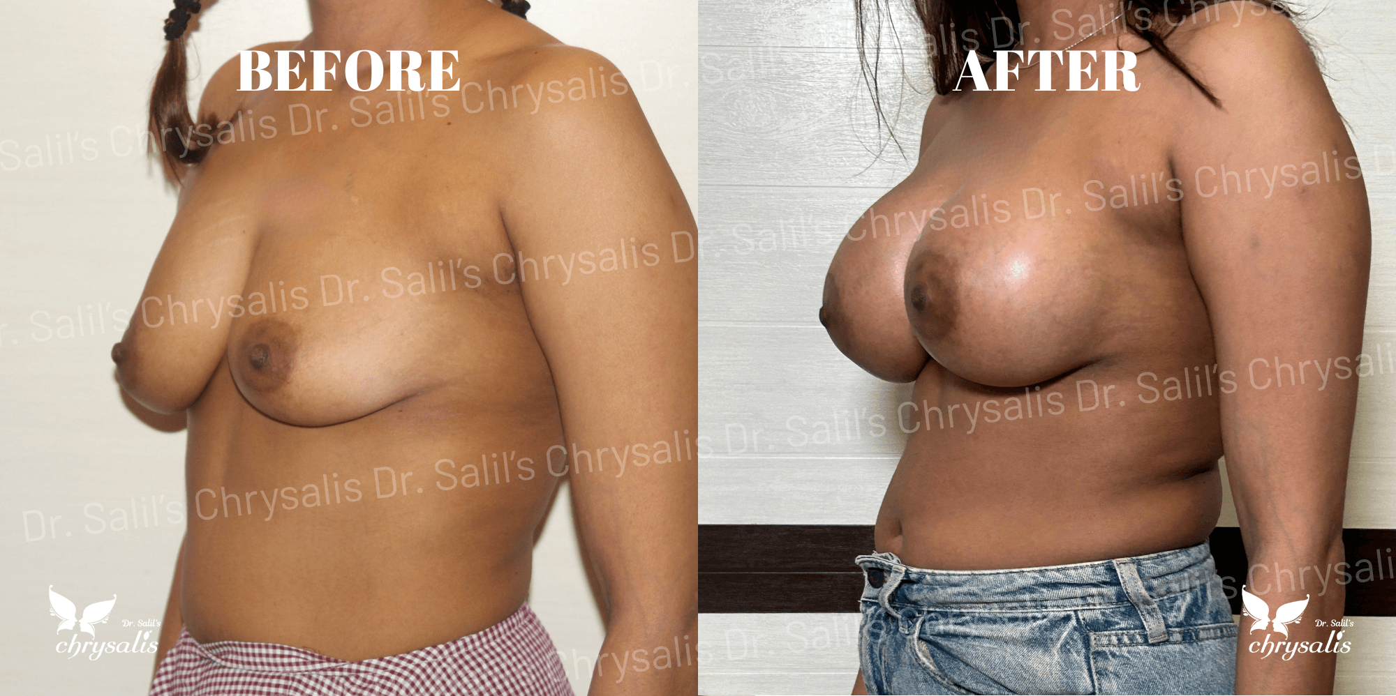 breast implant before and after Chrysalis Clinic Pune