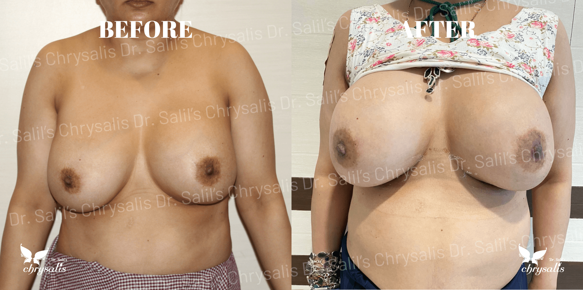 breast implant before and after Chrysalis Clinic Pune