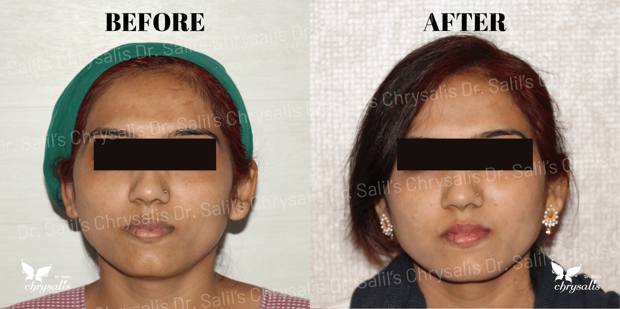 face fat grafting before and after at Chrysalis Clinic Pune