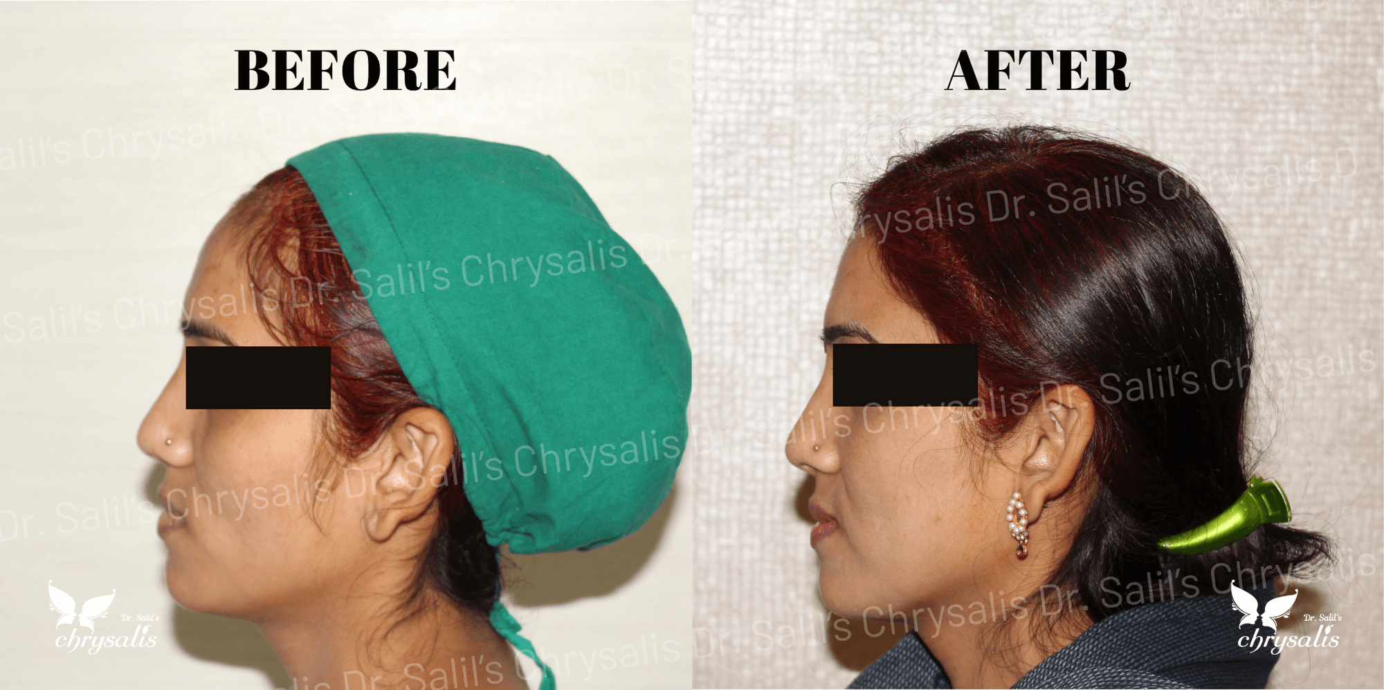 face fat grafting before and after at Chrysalis Clinic Pune