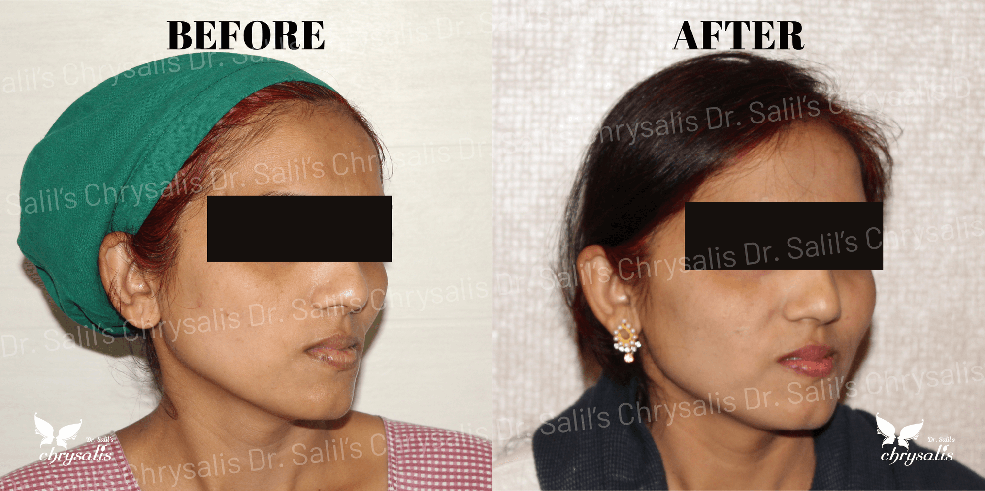 face fat grafting before and after at Chrysalis Clinic Pune
