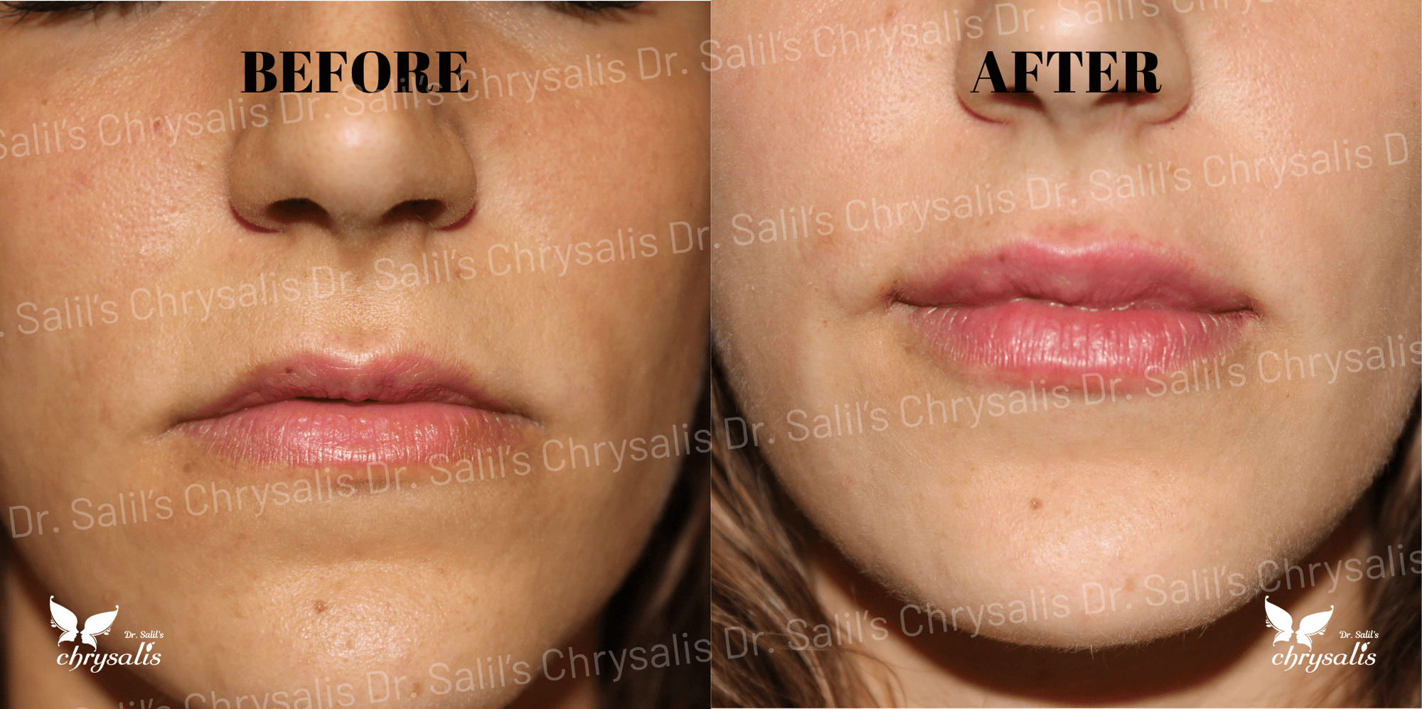 lip filler before and after at Chrysalis Clinic Pune
