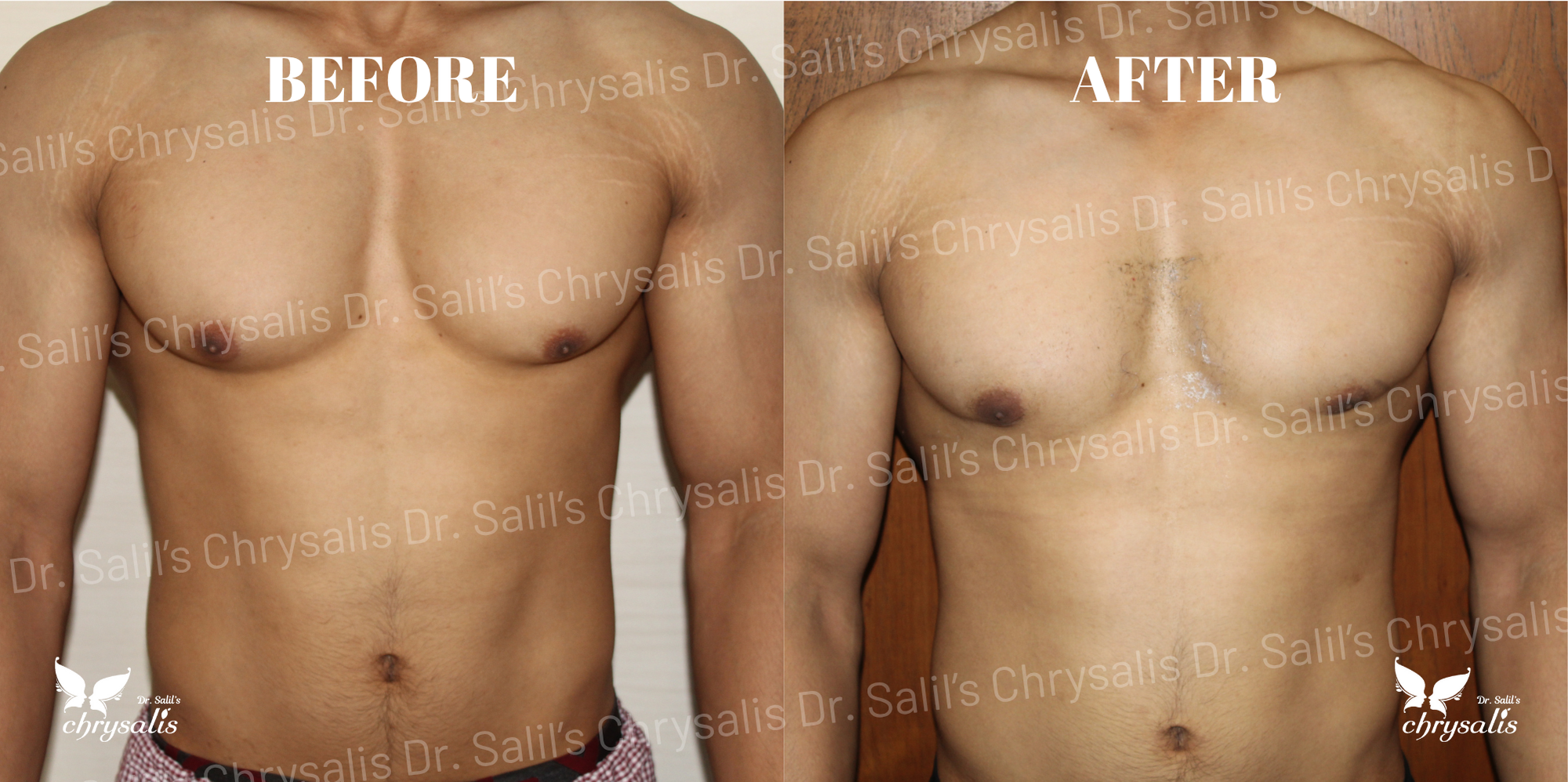 gynecomastia before after Pune