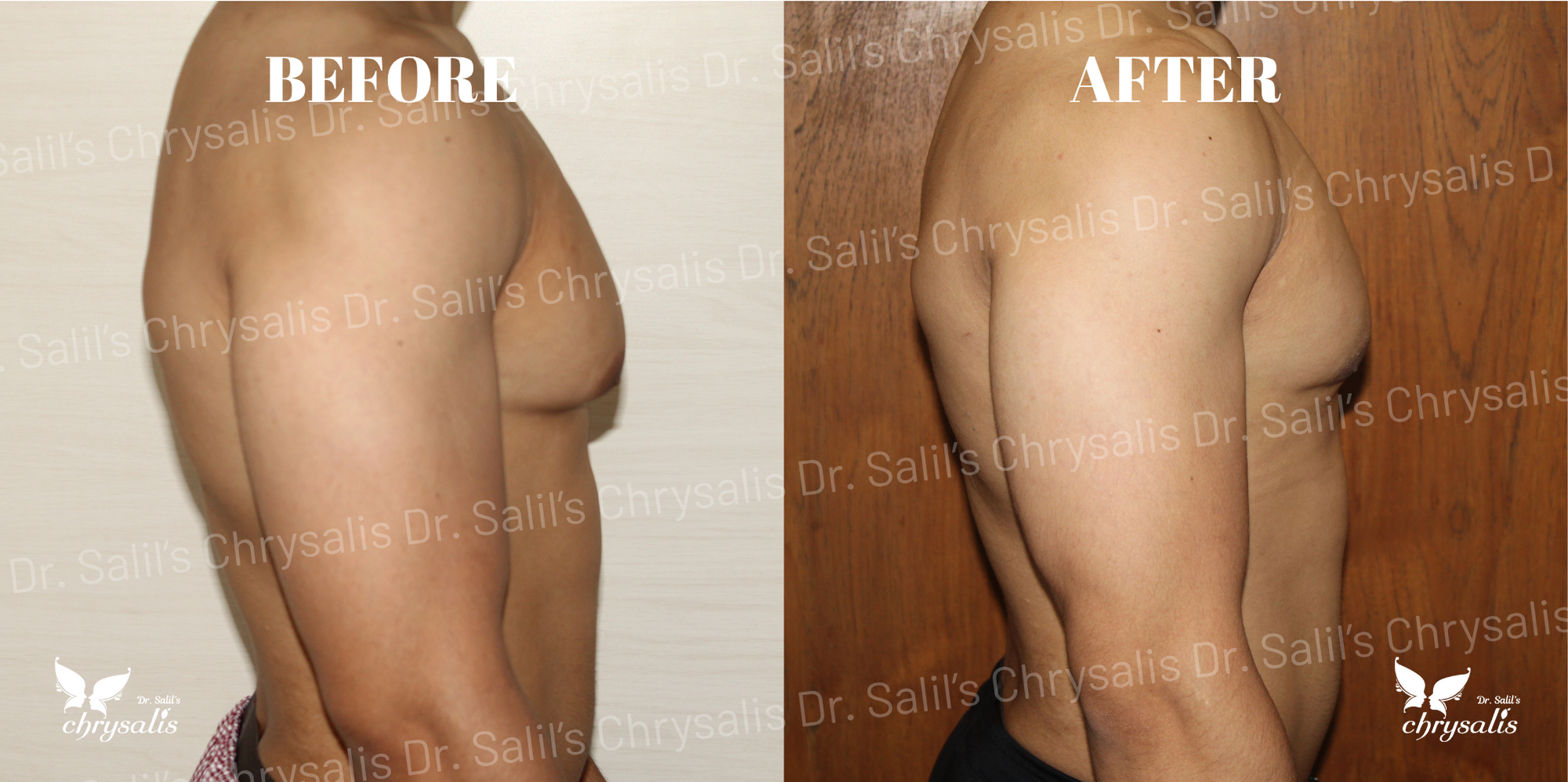 gynecomastia before after Pune