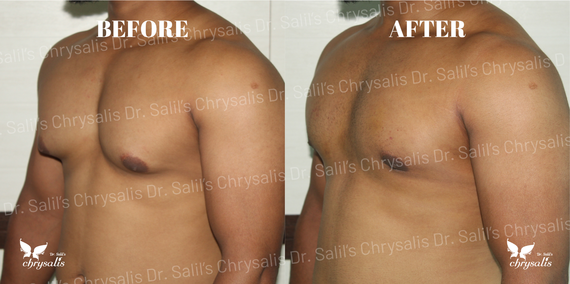 gynecomastia before after Pune