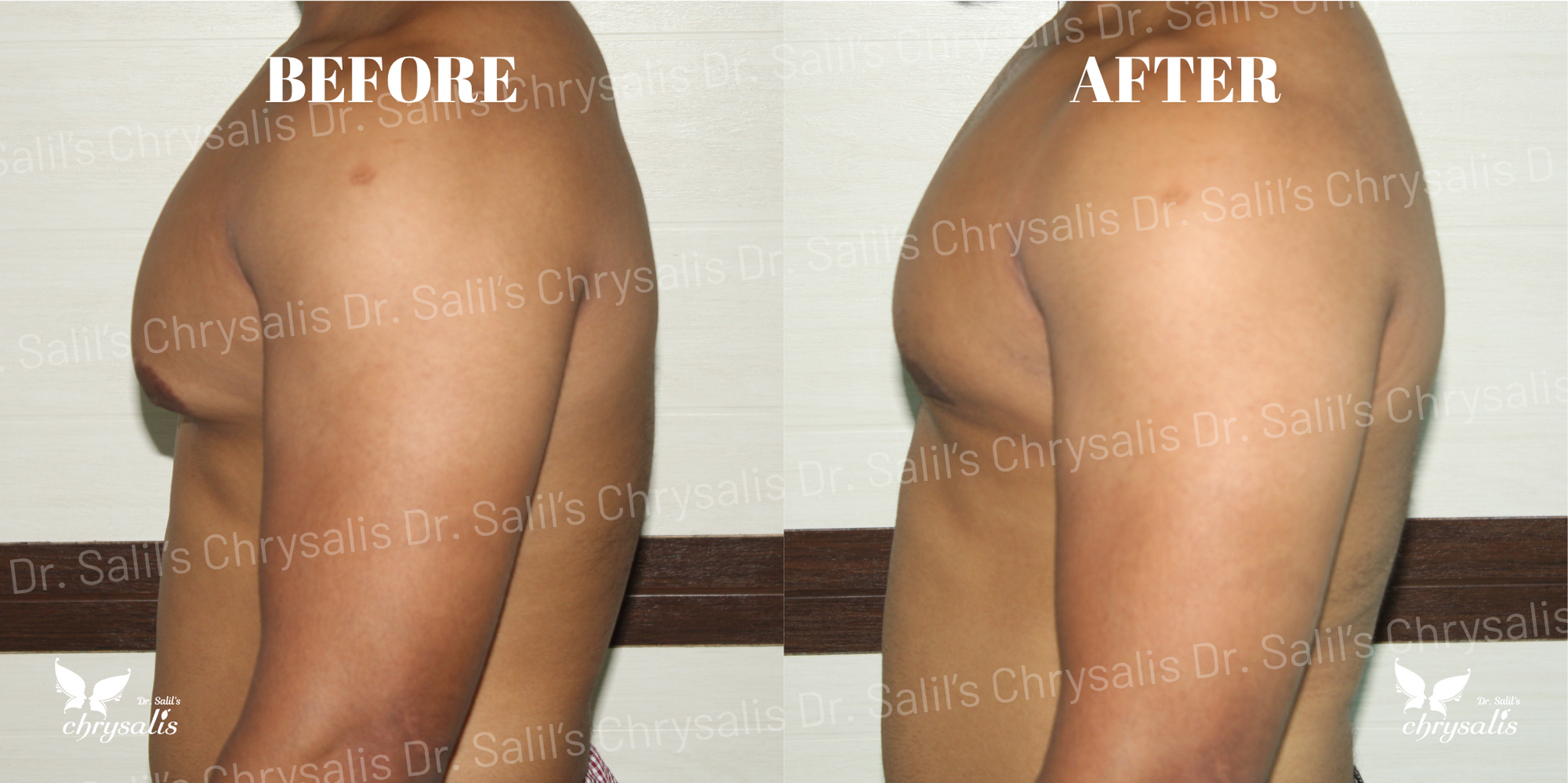 best gynecomastia doctor Pune