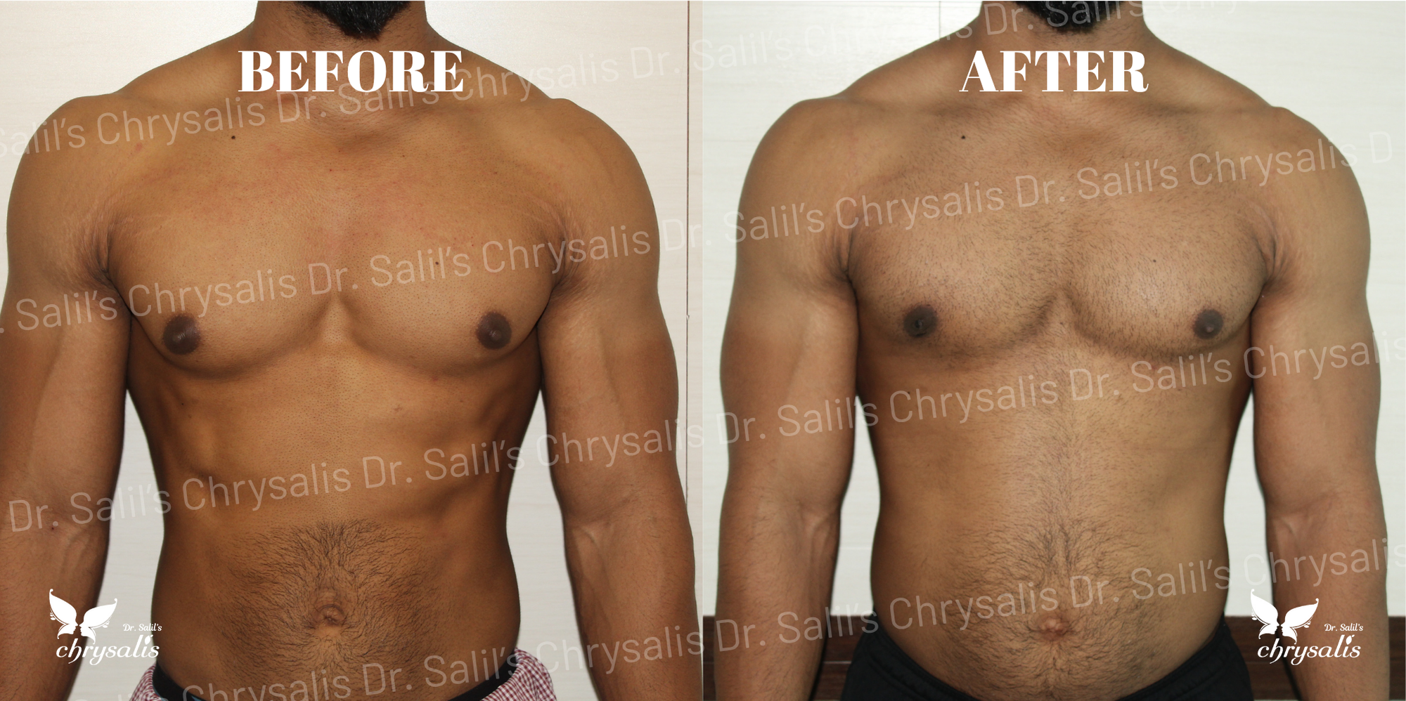 best gynecomastia doctor Pune
