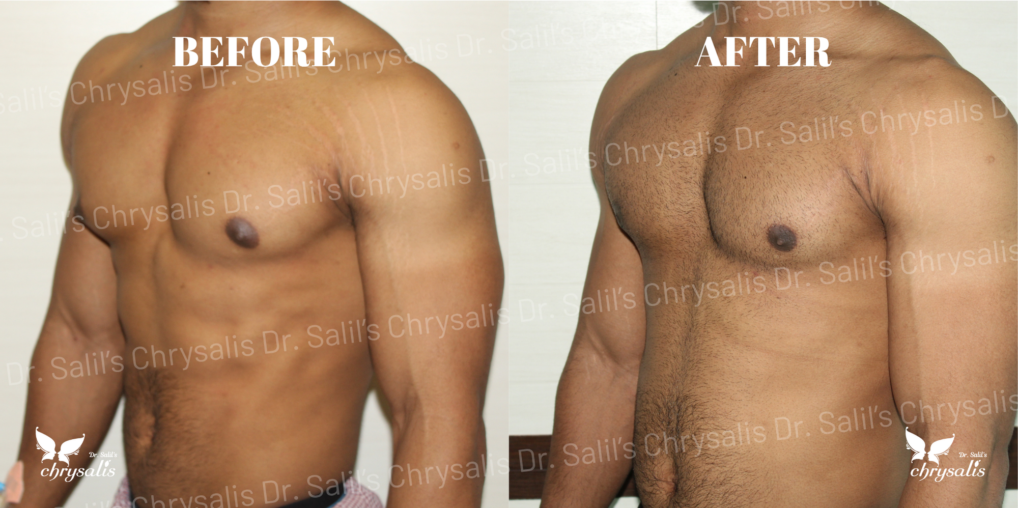best gynecomastia doctor Pune