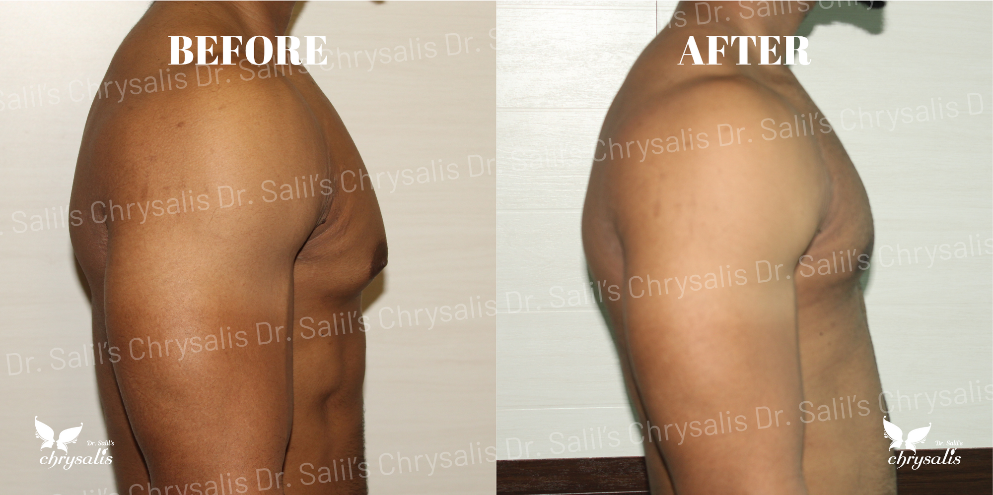 best gynecomastia doctor Pune