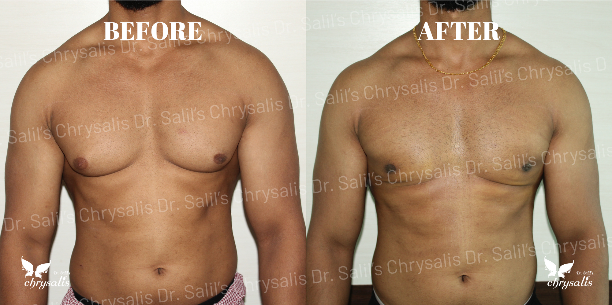 gynecomastia surgery cost Pune