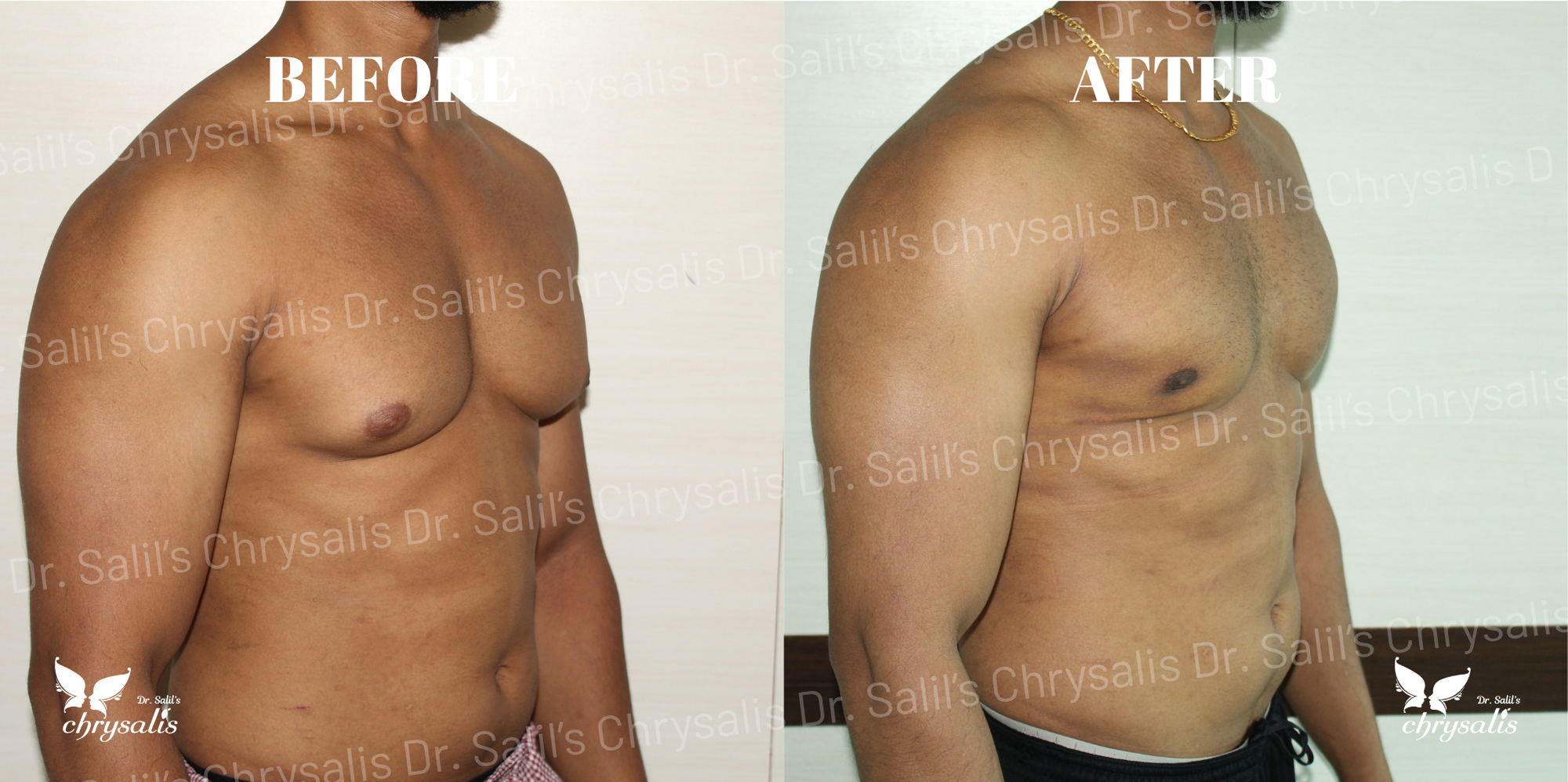 gynecomastia surgery cost Pune