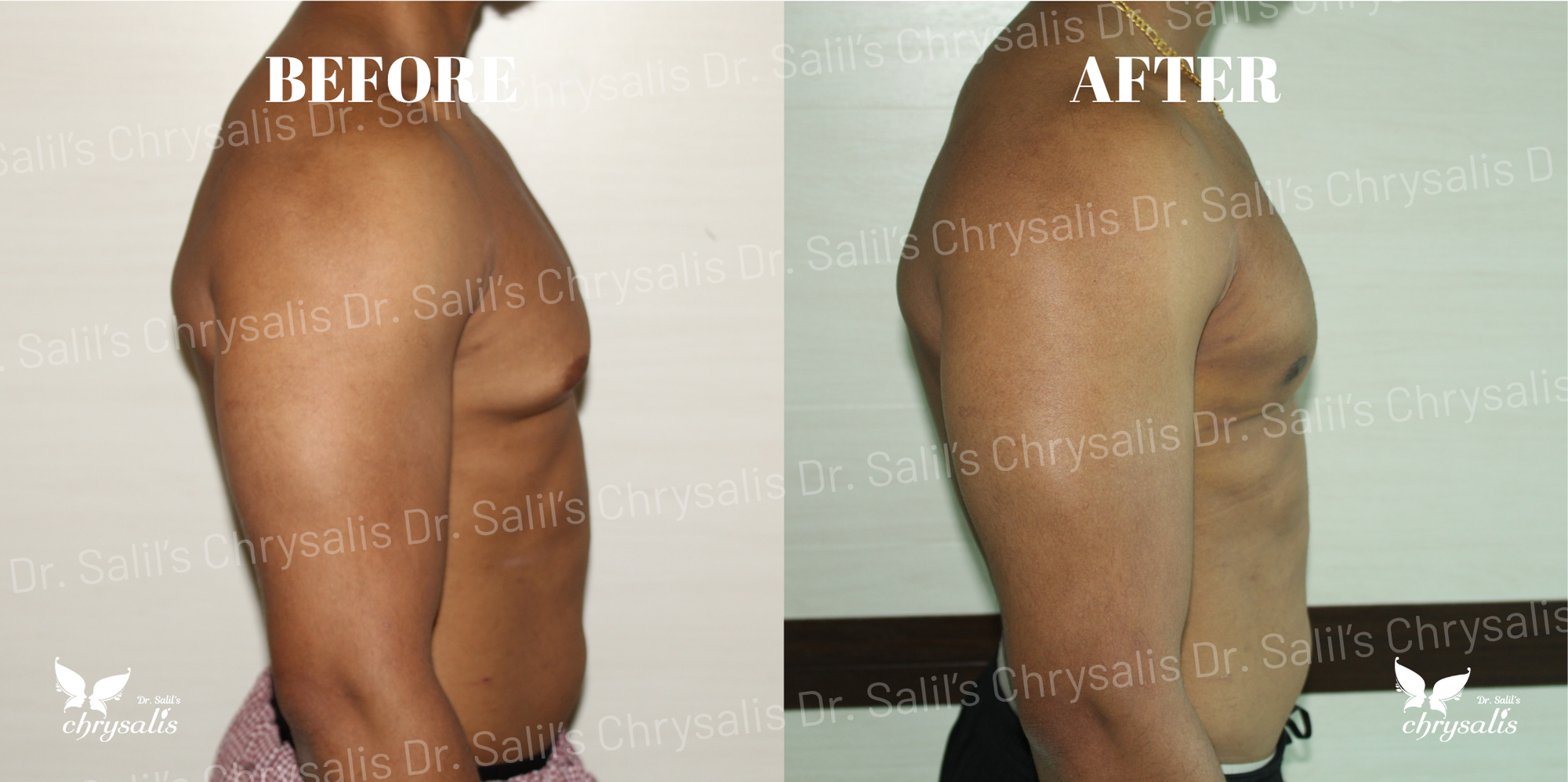 gynecomastia surgery cost Pune