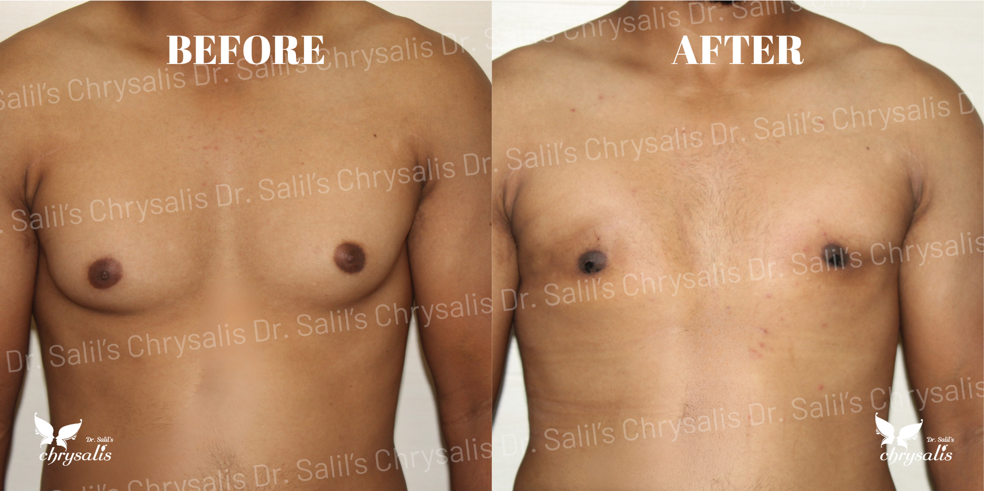 gynecomastia surgery cost Pune
