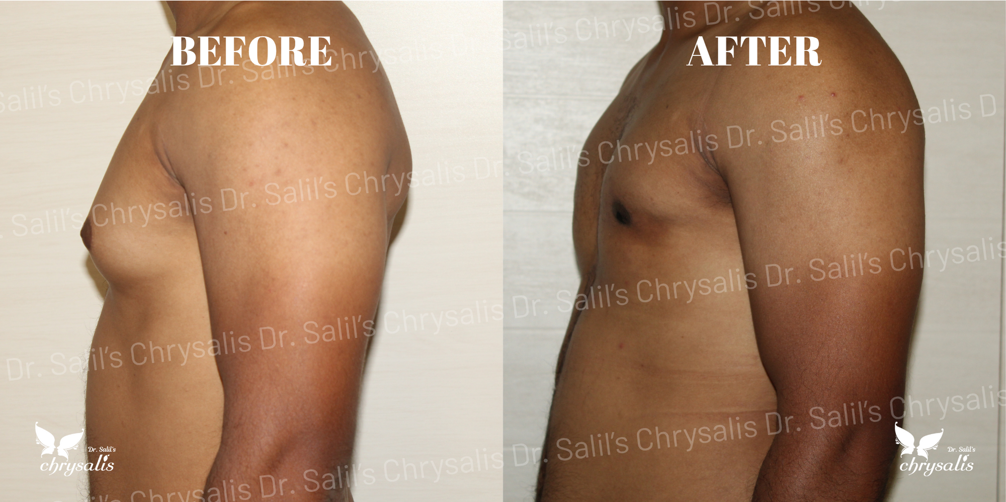 male chest fat removal Pune