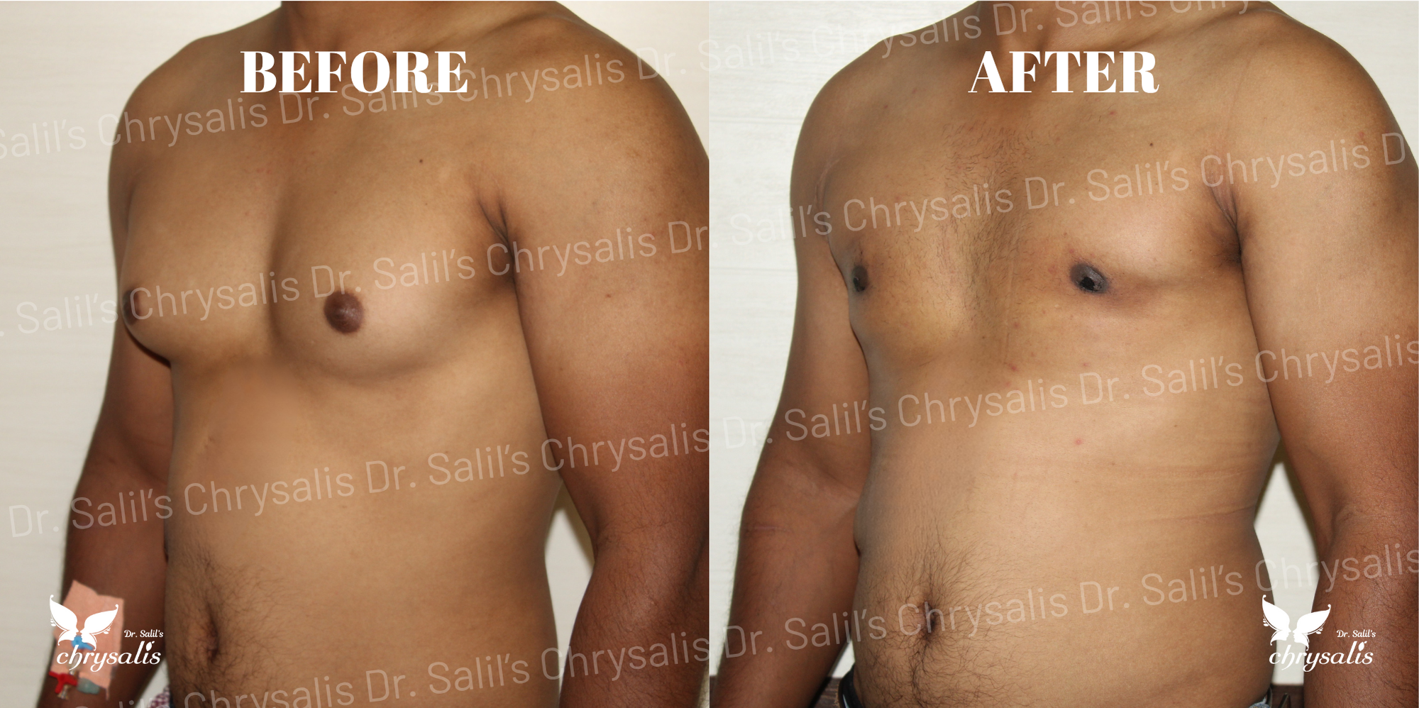 male chest fat removal Pune