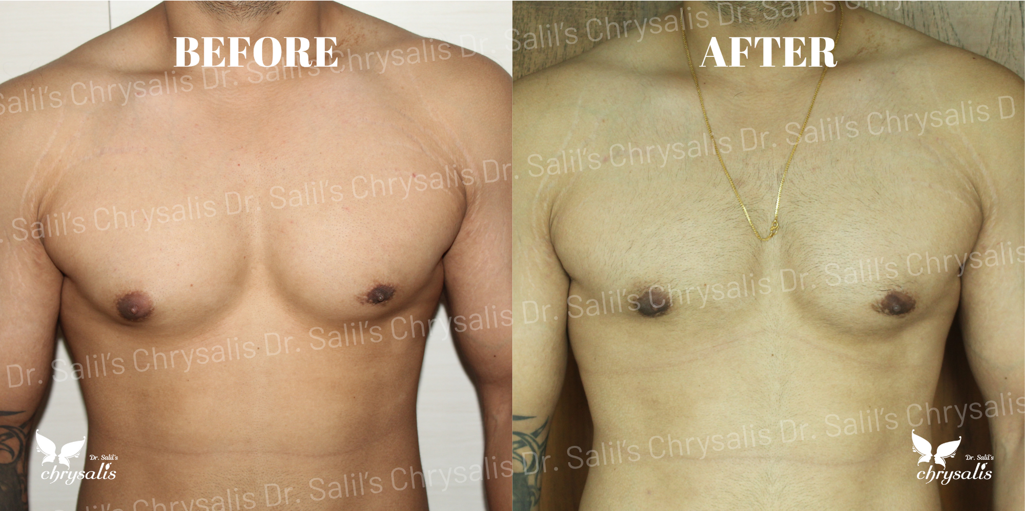 male chest fat removal Pune