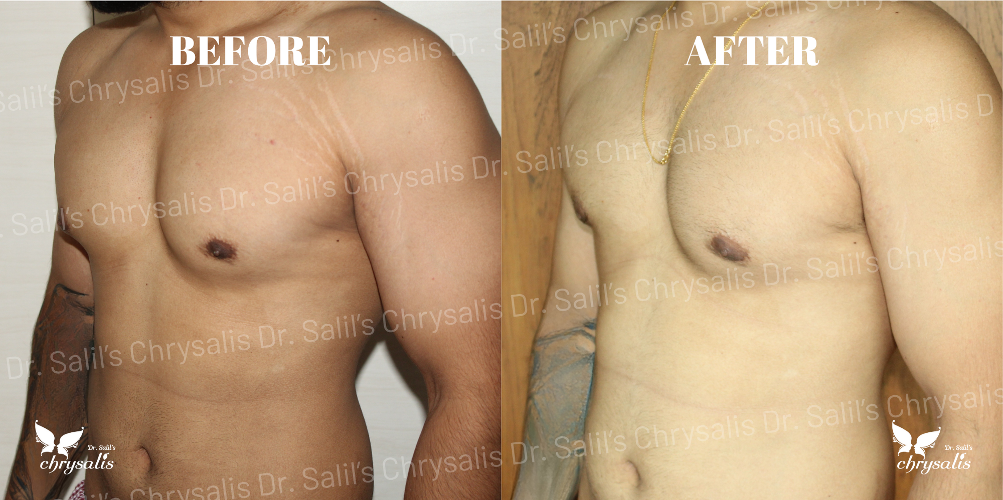 gynecomastia treatment Pimpri Chinchwad