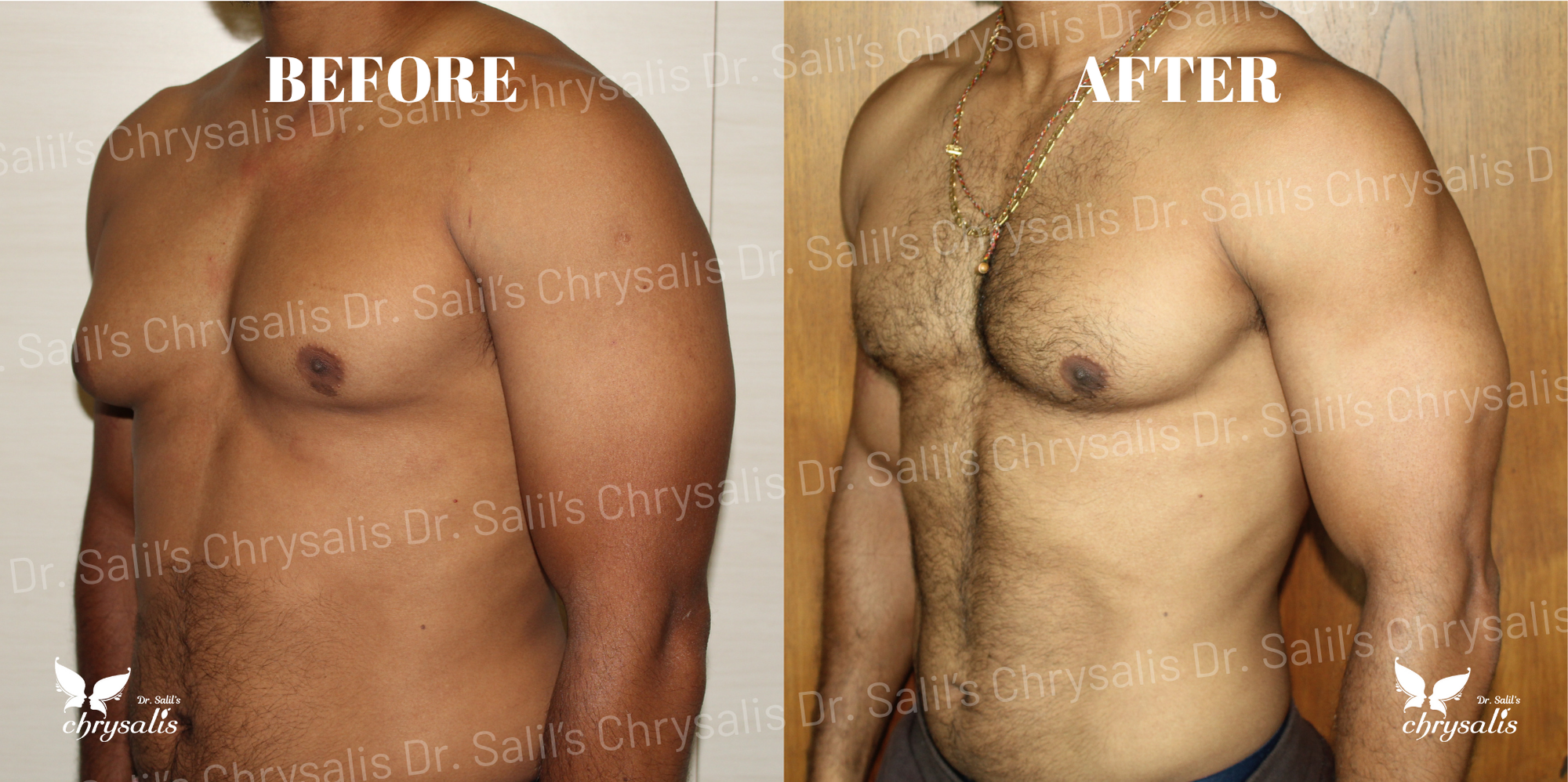male breast reduction Pune