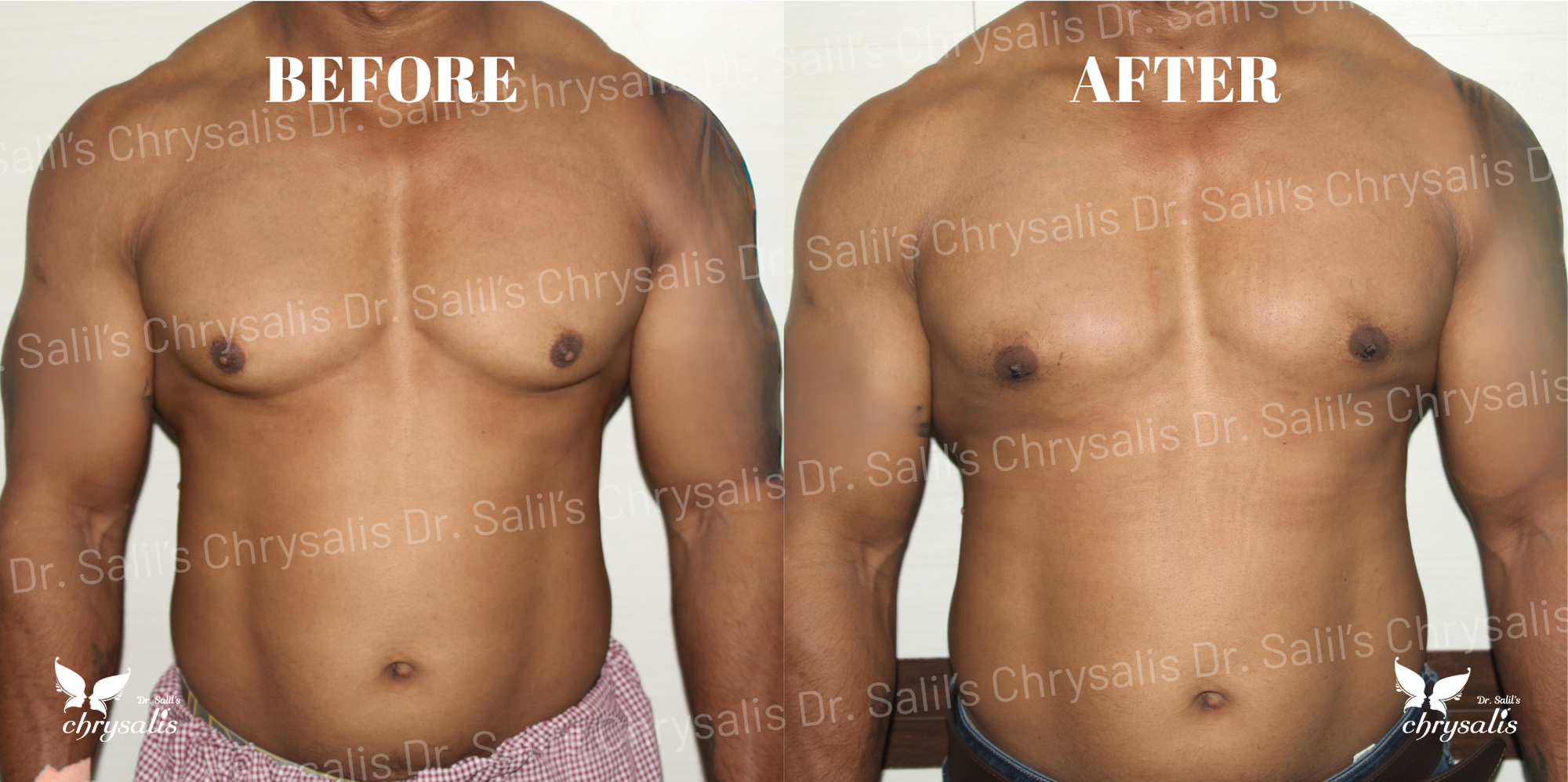 male breast reduction Pune