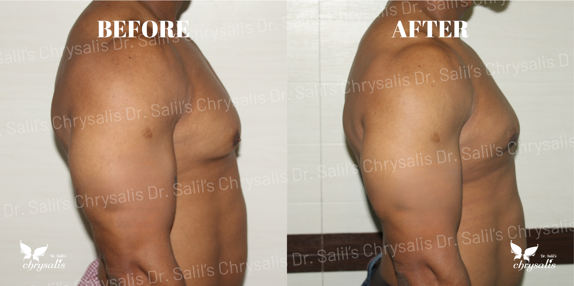 male breast reduction Pune
