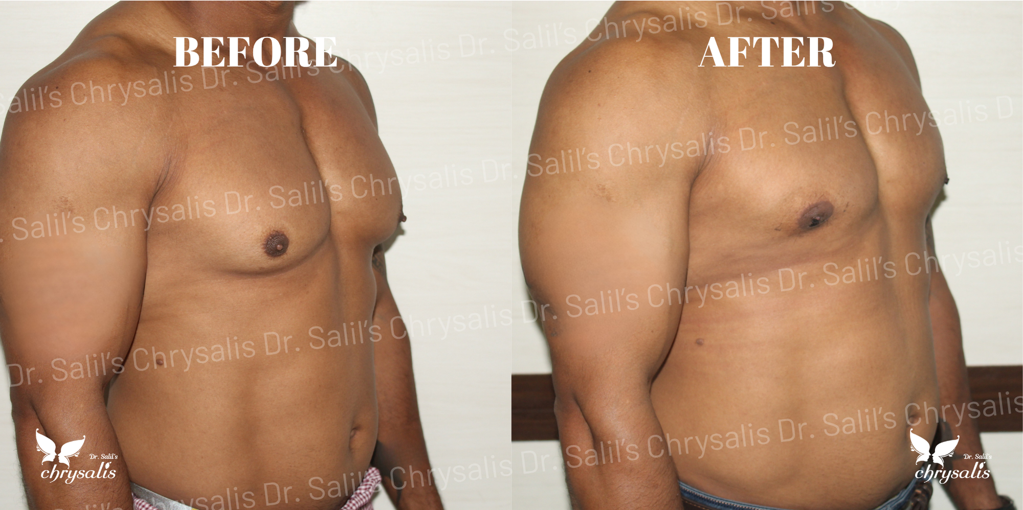male breast reduction Pune