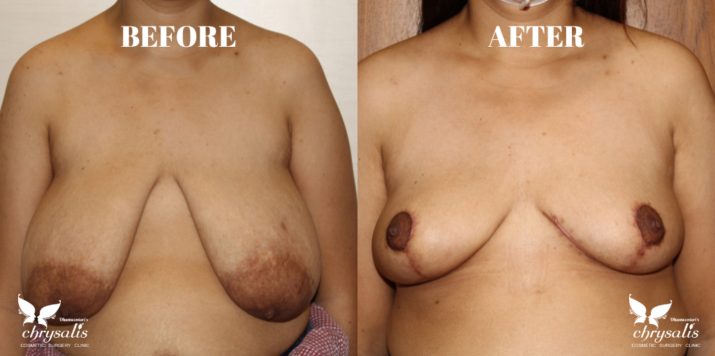 liposuction before