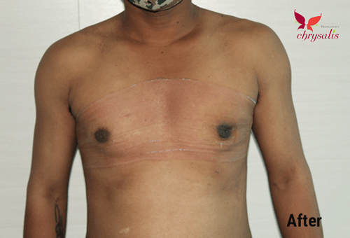 After-rhinoplasty