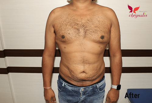 After-liposuction