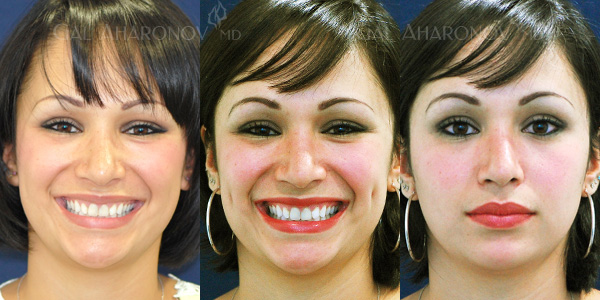 Before and After Dimple Creation Surgery