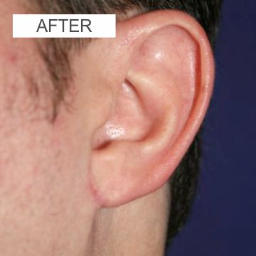 After Ear reshaping Surgery 