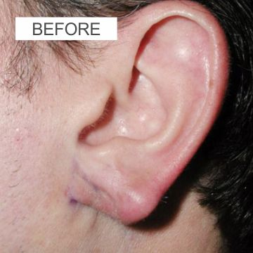 Before Ear reshaping Surgery 