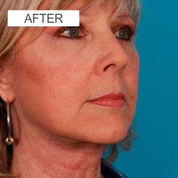 After facelift surgery