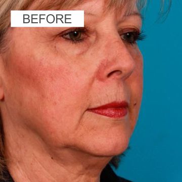 Before facelift surgery