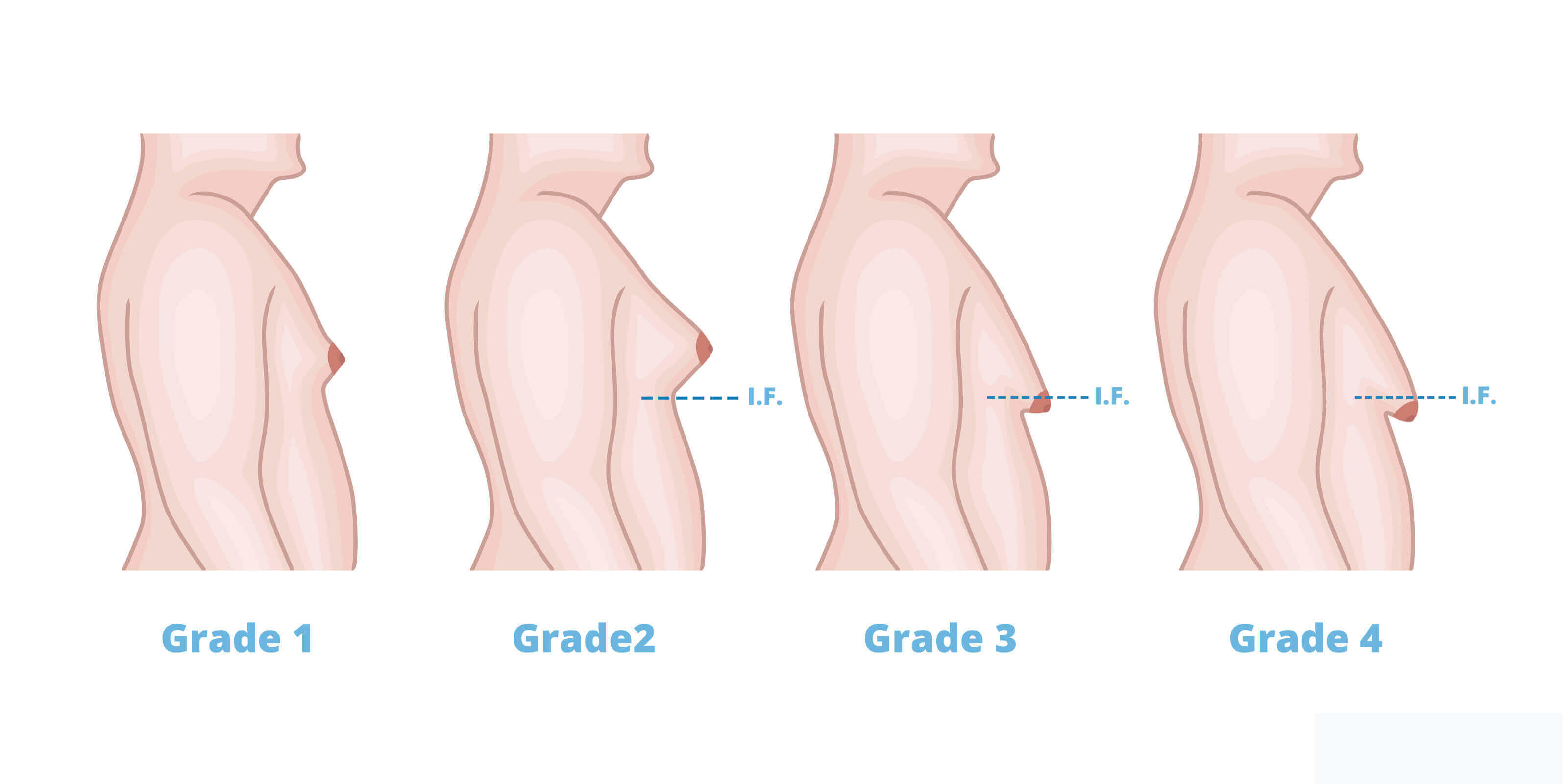 Gynecomastia Grade