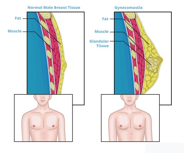 Normal male Breast Tissue vs Gynaecomatia