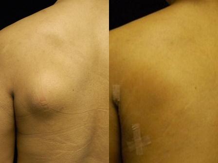 Lipoma Treatment before and after