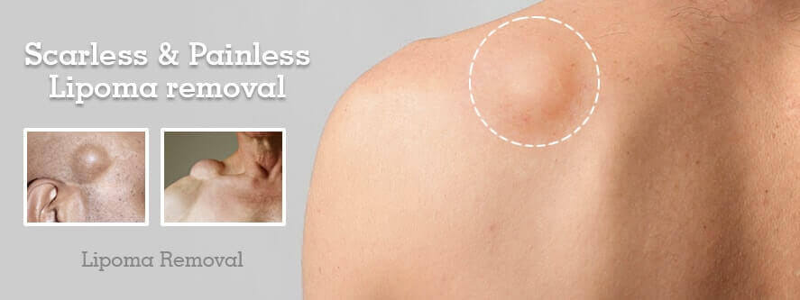 Scarless and Painless Lipoma removal