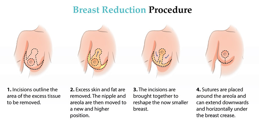 Breast Reduction Surgery Procedure