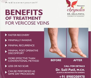 Benefits of treatment for Varicose Veins